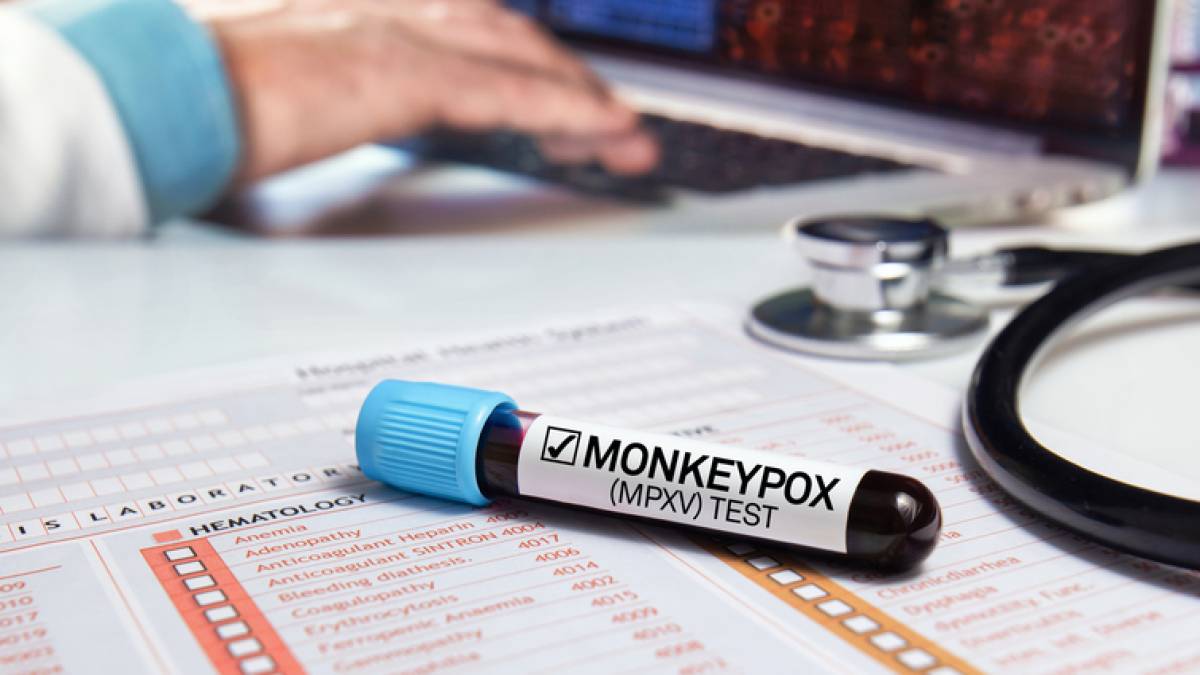 В Україні підтвердили другий випадок мавпячої віспи – МОЗ